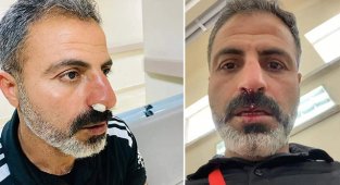 Karaköprü Belediyespor personeli burnu kırıldı