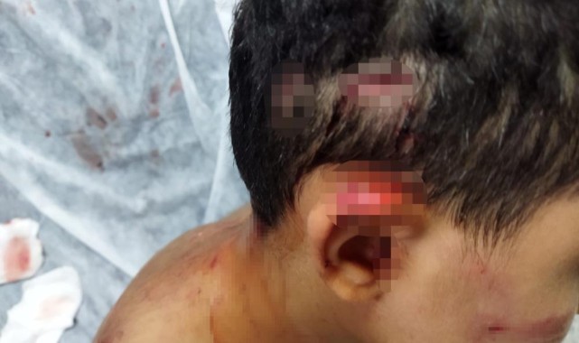 Gaziantep’te çocuk köpek saldırısına uğradı