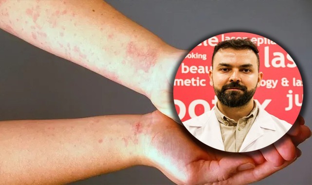Uyuz vakalarında artış, bazı kremlere direnç göstermeye başladı