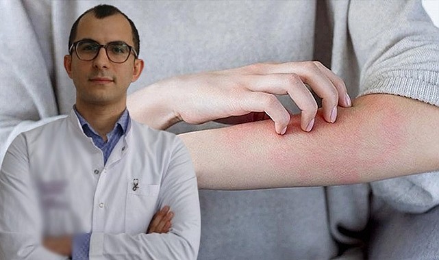 Uzmandan uyarı! uyuz tedavisinde ilaçlar yetersiz kalabiliyor