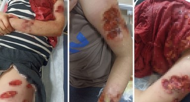 Şanlıurfa'da köpek saldırısına uğrayan genç kız Komşu ilde tedavi ediliyor