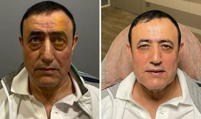 Urfalı sanatçının estetik haline yorum yağdı!