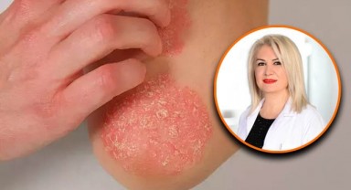 Dikkat! Egzama hastaları güneşten korunmalı