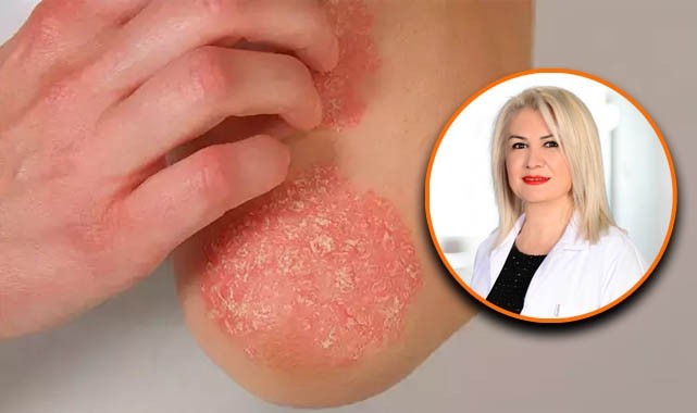 Dikkat! Egzama hastaları güneşten korunmalı