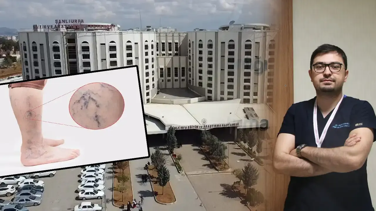 Şanlıurfa Eğitim ve Araştırma Hastanesinde varis tedavisinde modern yöntemler